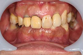 セラミック全体治療前の歯