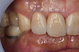 セラミック全体治療後の歯
