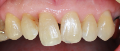 治療後の歯茎02