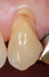 治療前の歯茎03