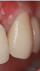 治療後の歯茎05