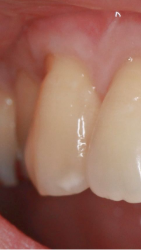 治療後の歯茎06