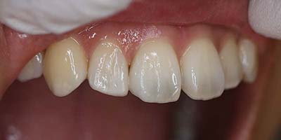 すきっ歯症例4after