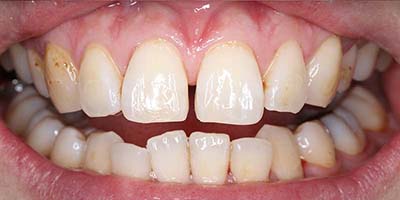 すきっ歯症例3before