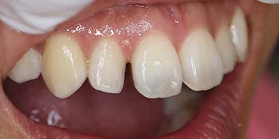 すきっ歯症例4before