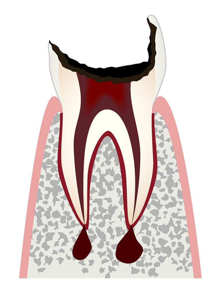歯根まで進行したむし歯のイラスト