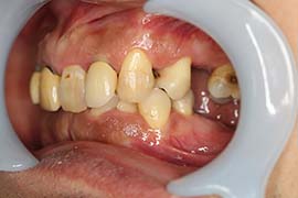 セラミック治療前の歯