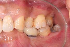 セラミック全体治療前の歯