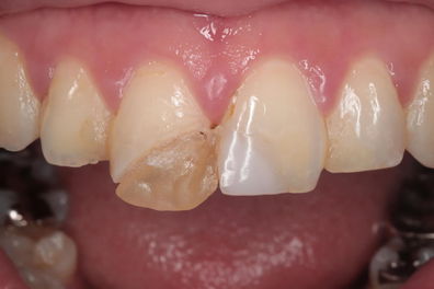 歯が折れた治療前の歯