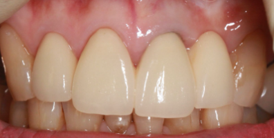 セラミック治療後の歯