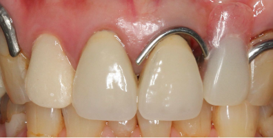 セラミック治療前の歯