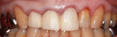 治療前の歯茎01
