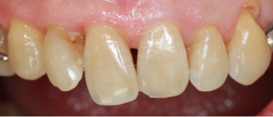 治療前の歯茎02
