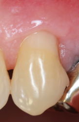 治療後の歯茎03