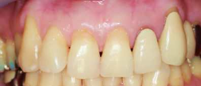 治療前の歯茎04