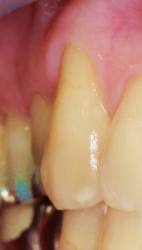 治療前の歯茎06