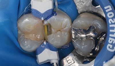 ダイレクトボンディング治療前の歯