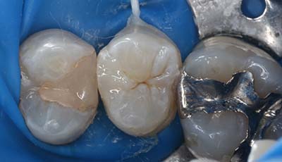 ダイレクトボンディング治療前の歯
